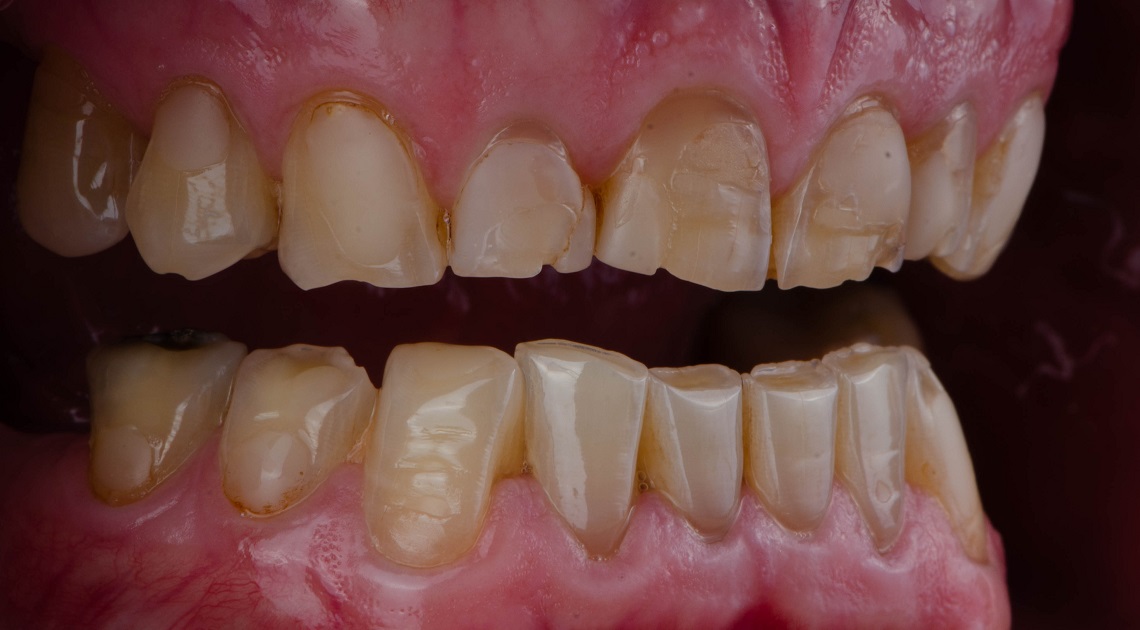 стертые зубы вид изнутри