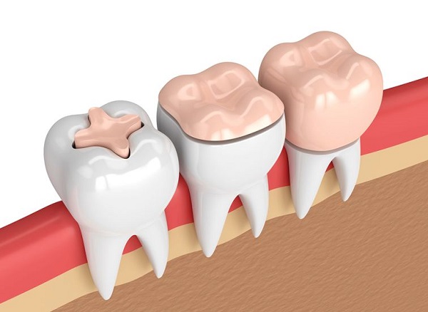 стоматологические коронки на зубы