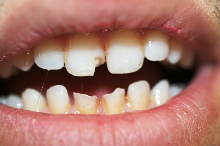 Третий шаг: сохранять отколовшийся кусочек зуба и не потерять