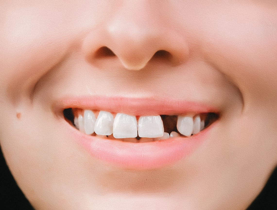 Симптомы сверхкомплектных зубов