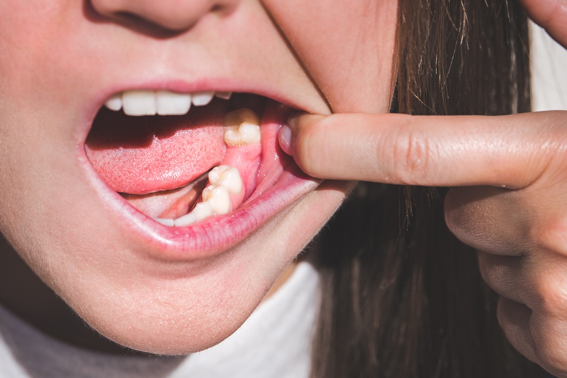 После удаления зубов: образ жизни, питание и правила гигиены - рекомендации специалистов