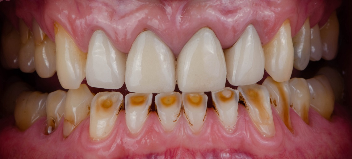 повышенная стираемость зубов