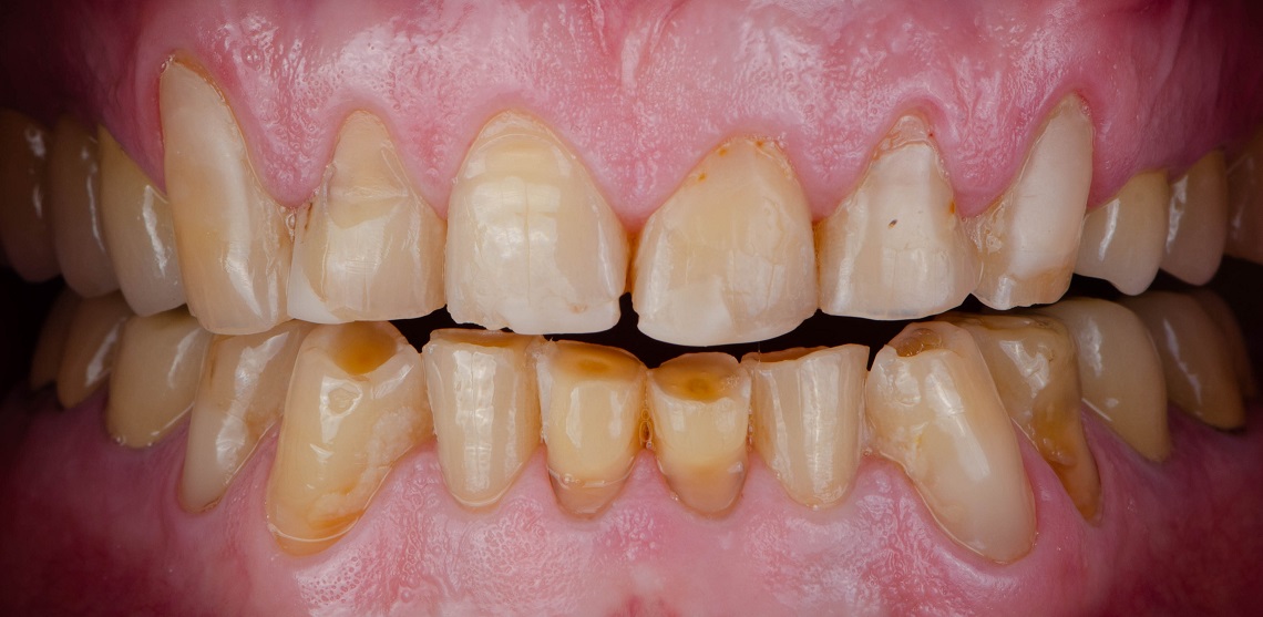 стираемость зубов патологическая