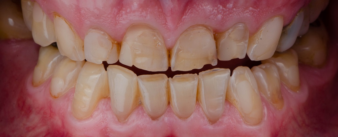 стираемость зубов при бруксизме