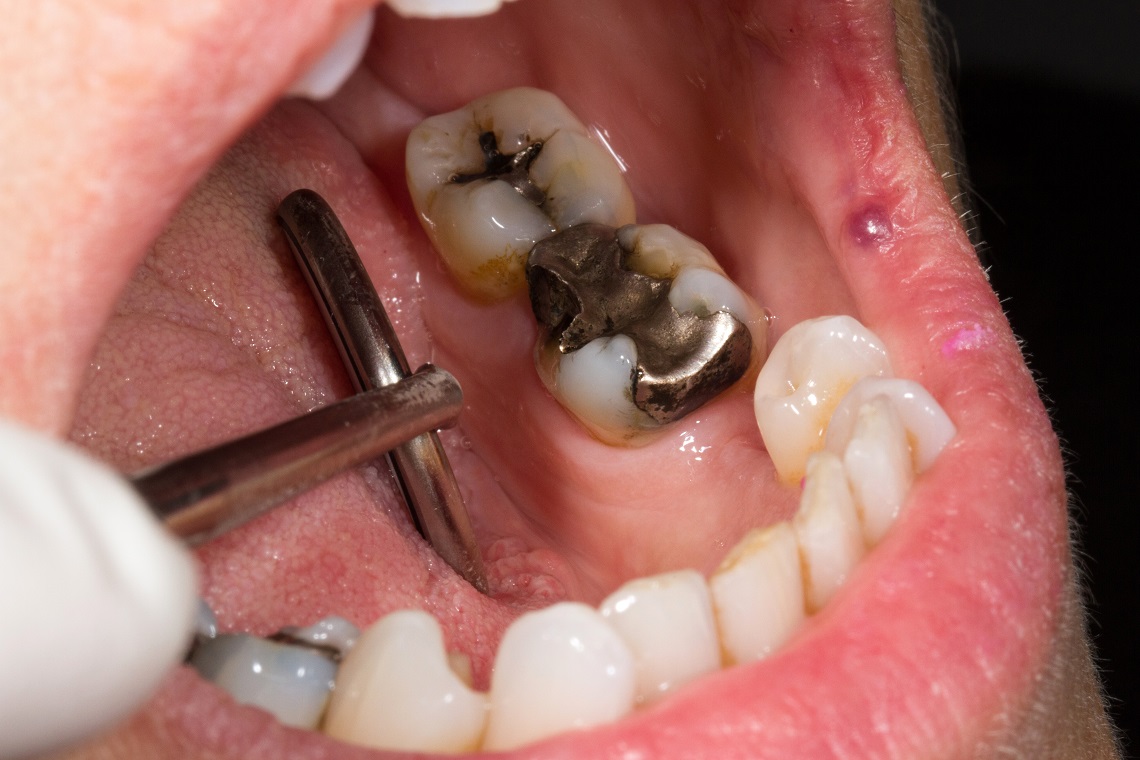 потемневший зуб от амальгамной пломбы