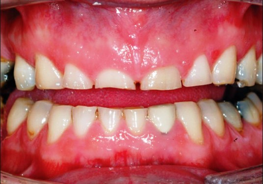 стираемость зубов при бруксизме