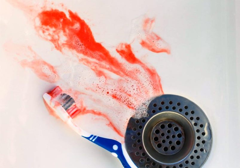 кровь во время чистки зубов