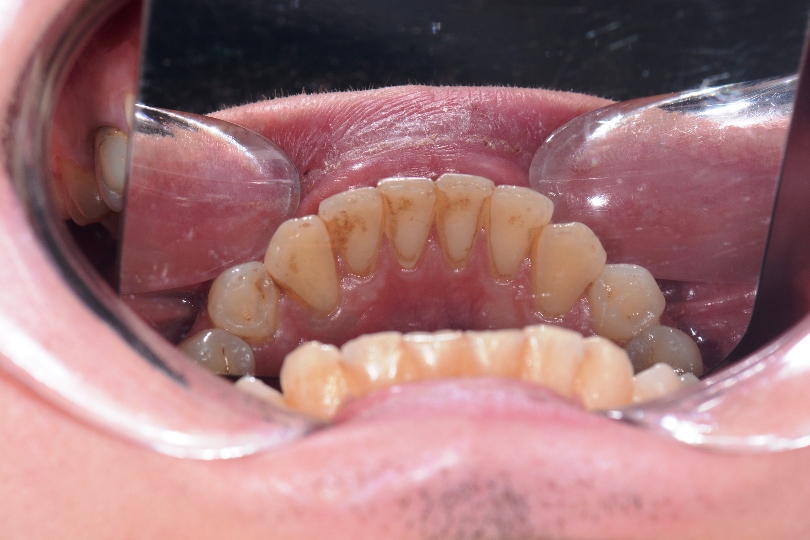 Зубы до и после чистки фото