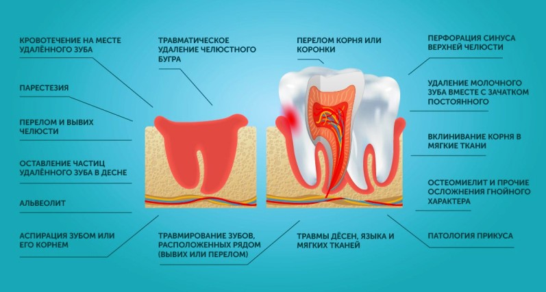 инфографика: осложнения после удаления зуба