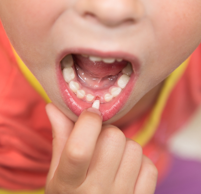 У ребенка шатается зуб: что делать если у ребенка шатается коренной или передний зуб
