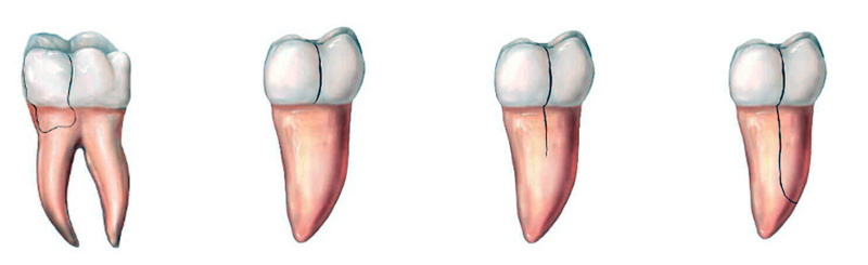 виды трещин на зубах