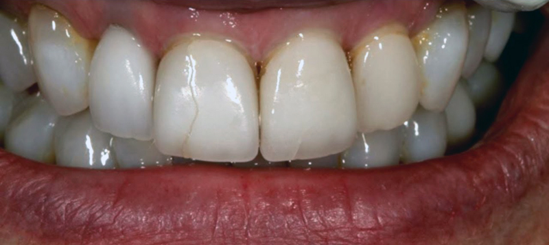 трещина на переднем зубе